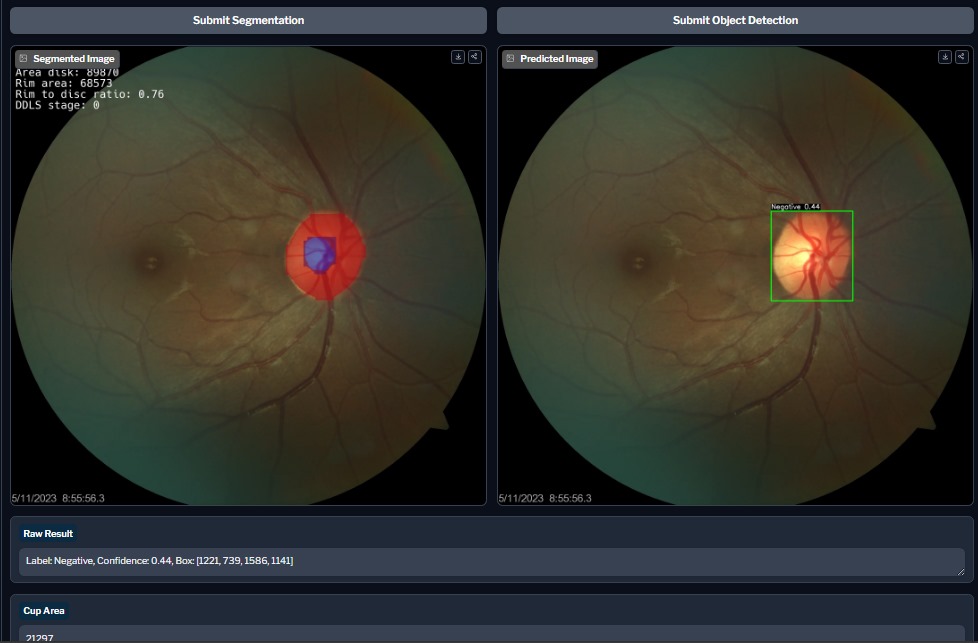 Glaucoma Analyzer